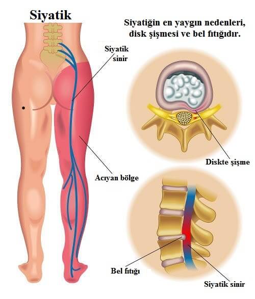 siyatik hastalığı