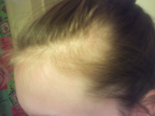 alopesi