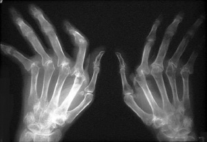 Romatoid Artrit Tedavisi İçin Doğal Çözümler