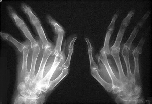 Romatoid Artrit Tedavisi İçin Doğal Çözümler