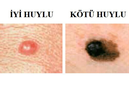 cilt kanseri