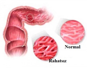Huzursuz Bağırsak Sendromunu Hafifleten Çaylar