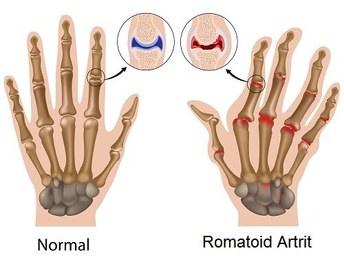 Romatoid Artrit Sorununuz Mu Var? İşte Birkaç Tavsiye