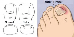 Tırnak Batması İçin Tedaviler