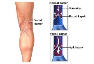 Varisli Damarlar İçin Uygulanabilecek 10 Bitkisel Tedavi