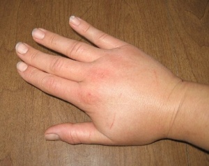 Ödem Azaltıcı Çaylar