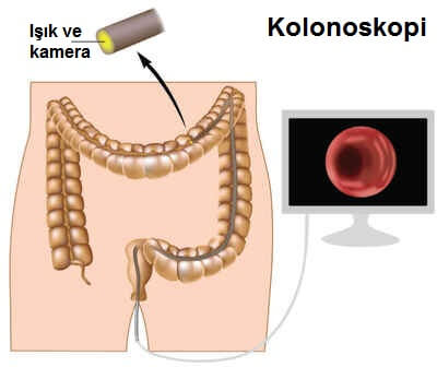 kolonoskopi