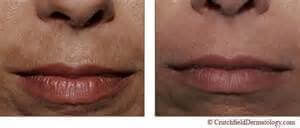 cilt rengi karşılaştırma