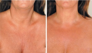 Boyun Kırışıklıkları İçin Doğal ve Etkili Çareler