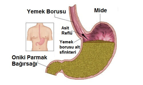 gastrik reflü