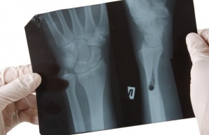 Kemik Sağlığı için Zararlı Olan Gıdalar