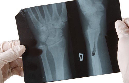 Kemik Sağlığı için Zararlı Olan Gıdalar