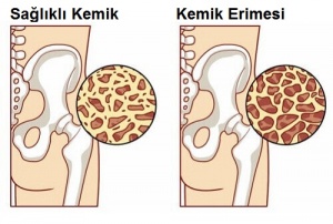 Kemik Erimesini Önlemeye Yardımcı 8 Gıda