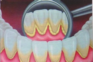 Doğal Yollarla Diş Plağından Kurtulmak