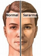 safra ve sararma