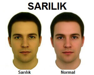 cildinizin gösterdiği işaretler