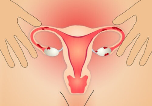 Beslenmeyle Endometriozis Tedavisi