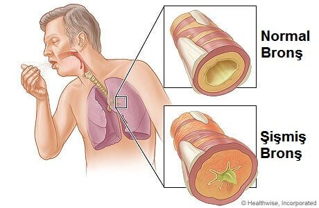 bronşların sağlığı normal bronş şişmiş bronş