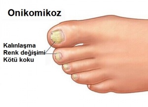 Onikomikoz: Tırnak Mantarı