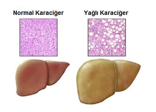 normal ve yağlı karaciğer