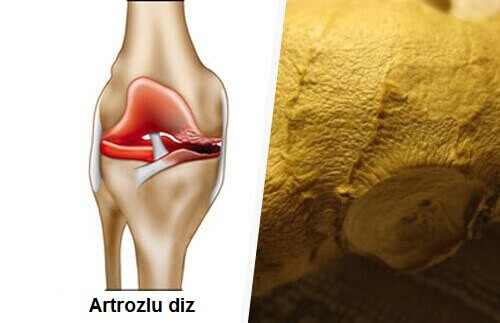 Osteoartrit Semptomları Nasıl Ortadan Kaldırılır?