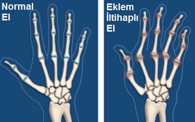 eklem iltihabı