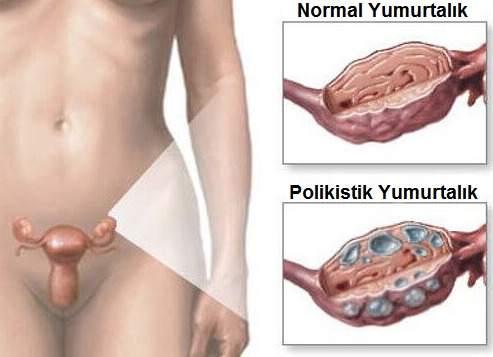 Polikistik Over Sendromu İçin Doğal Tedaviler