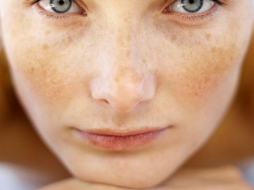 cilt lekelerini önlemek