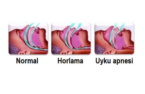 Horlamayı Durdurmak İçin Kolay İpuçları