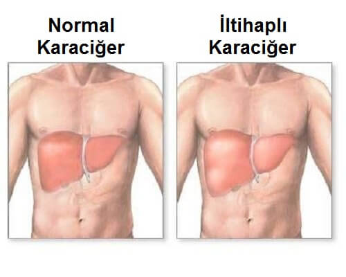 Karaciğer İltihabı: Semptomlar ve Doğru Beslenme