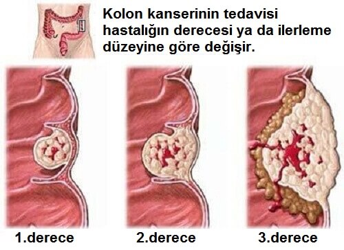 Kolon Kanseri: Bilmeniz Gerekenler