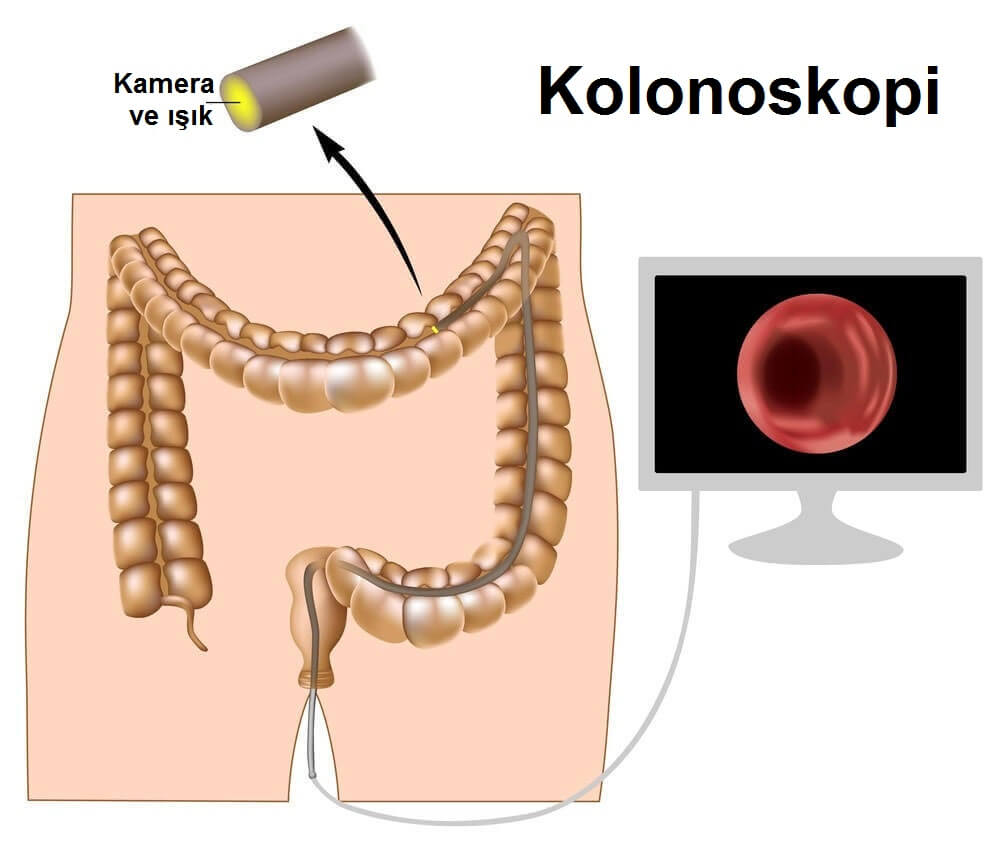kolonoskopi