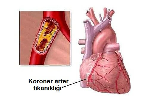 Kalp Sorunlarına Neden Olan 8 Alışkanlık