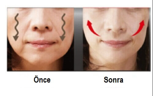 Sarkık Yanakları Kaldırmak için 4 Öneri