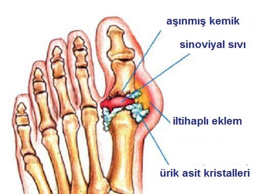 Gut Ağrısı İçin Doğal Ev Tarifleri