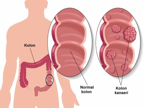 Kolon Kanserinden Korunmak için 5 Öneri