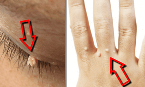 Doğal Yoldan Siğilleri Yok Edin