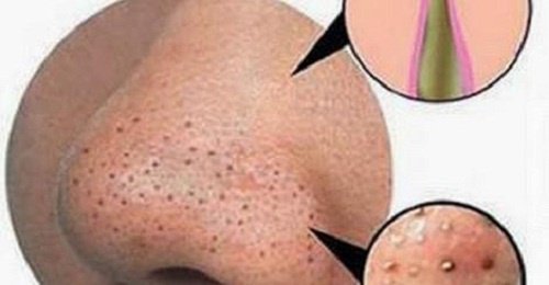 Sivilcelerden ve Siyah Noktalardan Kurtulun