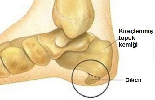 Topuk Dikeni: Belirtileri, Tanı ve Tedavisi
