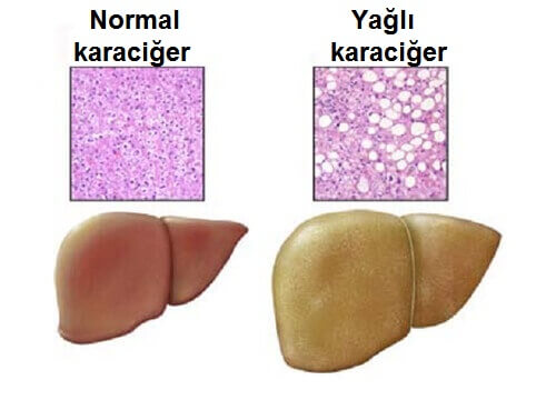 karaciğer yağlanması