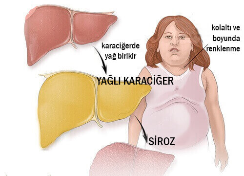 Karaciğer Yağlanmasının Belirtileri