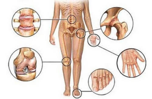 Eklem Ağrısı İçin 5 Doğal İltihap Sökücü
