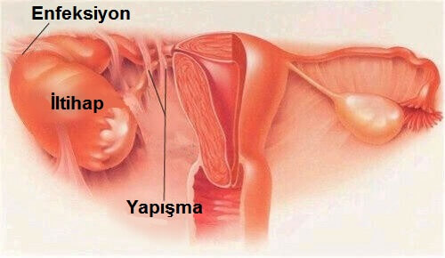 Pelvik İnflamatuar Hastalık (PID) Belirtileri