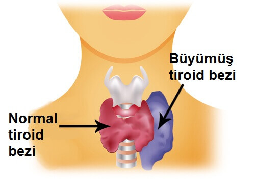 hipertiroid
