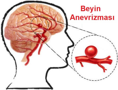 Anevrizma: Belirtilerini Saptayın ve Önleyin