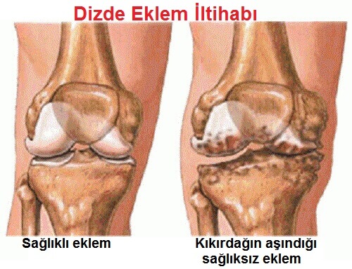 Eklem İltihabı: Belirtileri Ve Önlenmesi