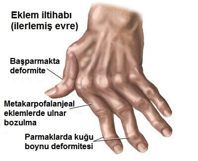 Eldeki Eklem Yangısı için 7 Tedavi Yöntemi