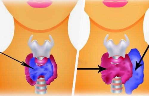 Hipotiroid ile Hipertiroid Arasındaki Fark