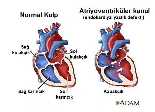 Bilmeniz Gereken 6 Kalp Hırıltısı Semptomu