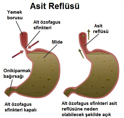 Gastroözofageal reflü oluşumunu gösteren bir grafik.